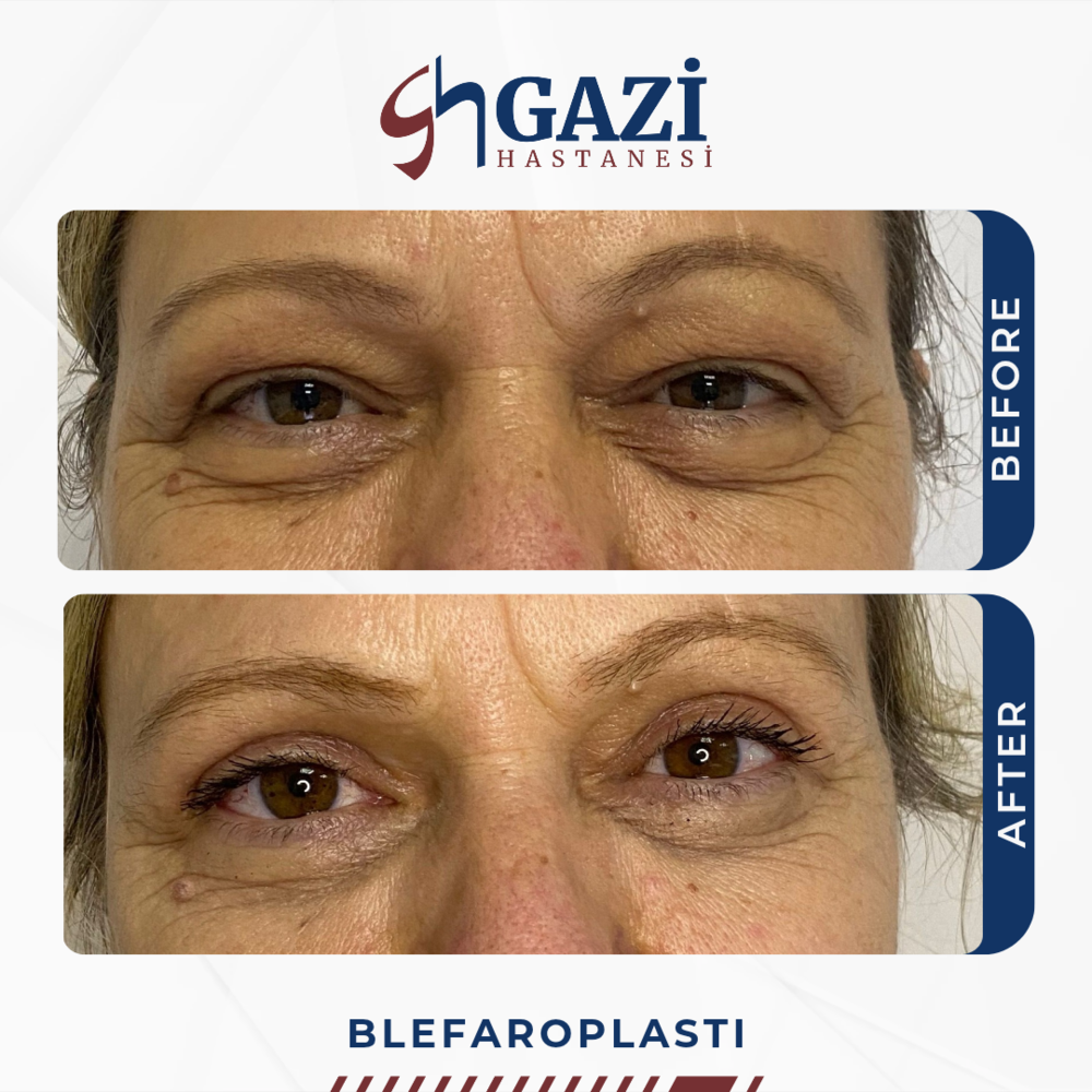 Before and After Result